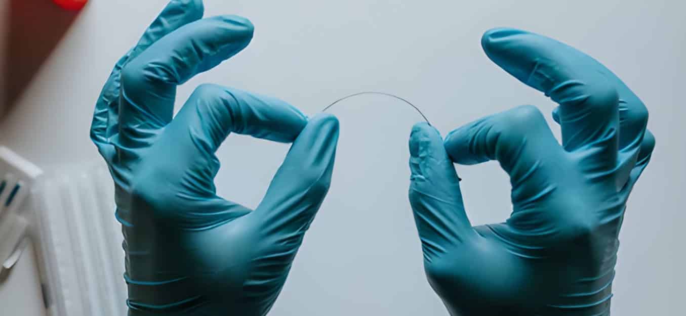 Sesión de acupuntura en la clínica de fisioterapia de Bilbao