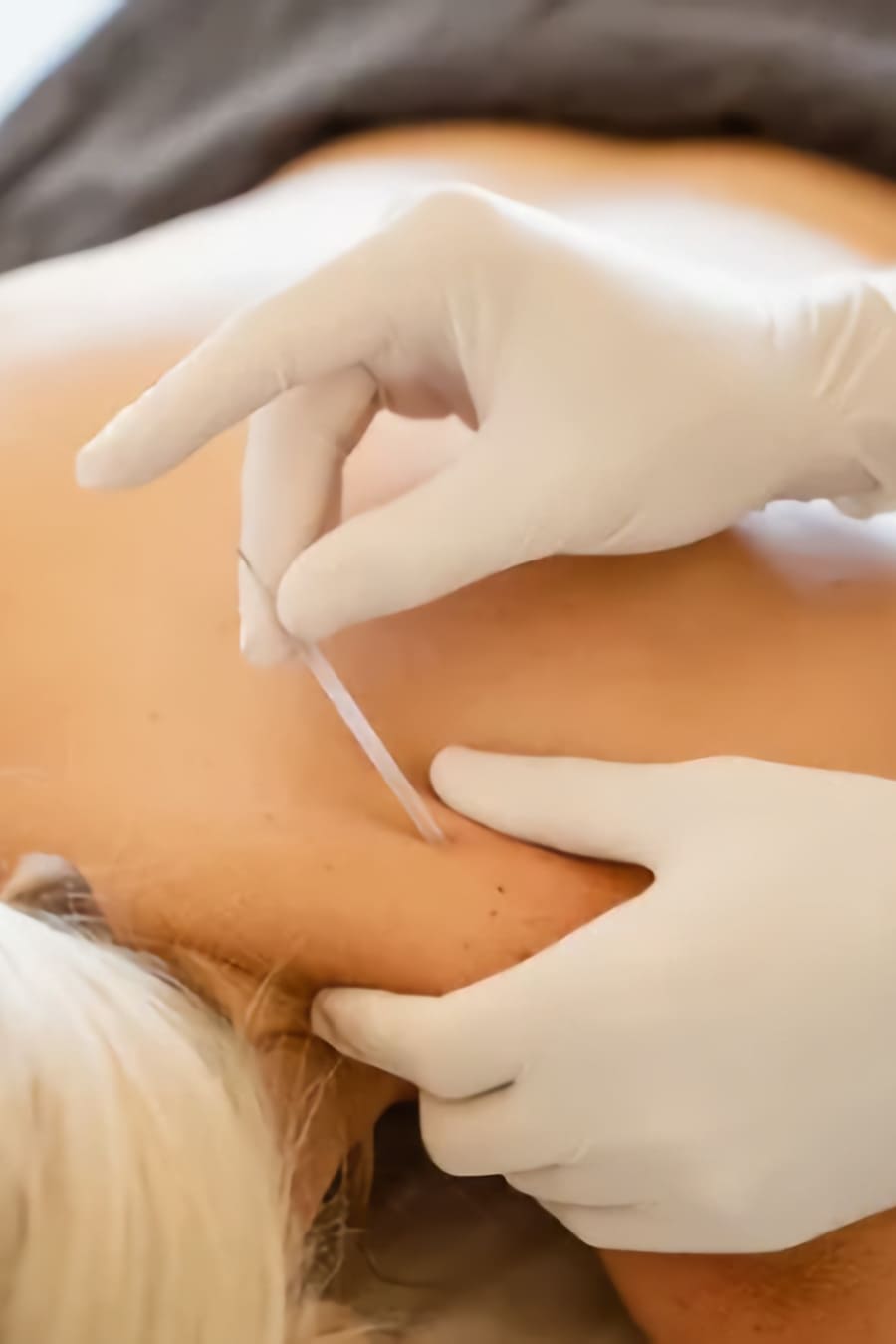 Tratamiento de punción seca en la clínica de fisioterapia de Bilbao